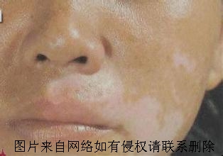 老年人为何容易患上白癜风