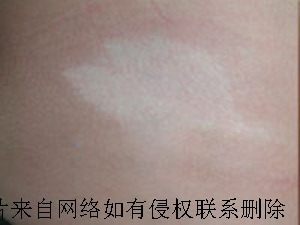 男性白癜风如何进行治疗好