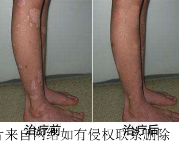 腿部白斑有什么治疗方法