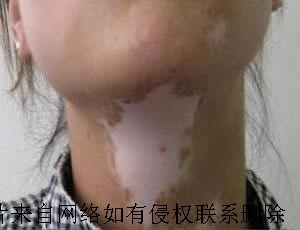 女性白癜风发病是什么原因